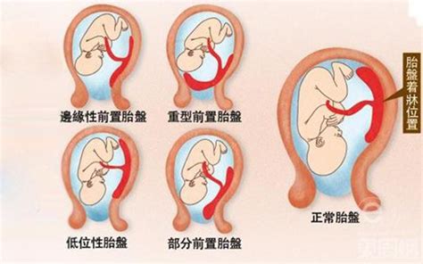 胎盤靠近子宮頸 門對人